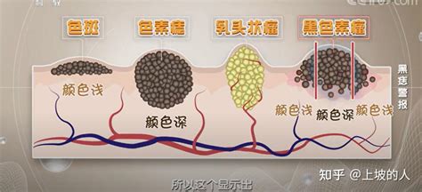 痣 顏色|是痣還是癌？醫師以ABCDE原則教你辨識